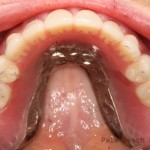 RL Implant Denture01