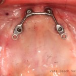 RL Implant Denture03