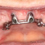 RL Implant Denture04
