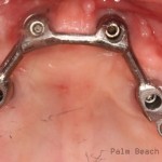 RL Implant Denture05