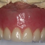 RL Implant Denture06