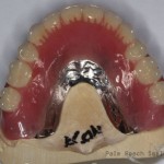 RL Implant Denture07