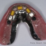 RL Implant Denture08