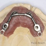 RL Implant Denture09
