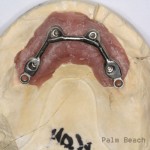 RL Implant Denture10