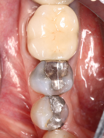 Tooth #29 has deep facial abfraction and large amalgam with cracks evident.  Tx Plan:  Build-up and crown.