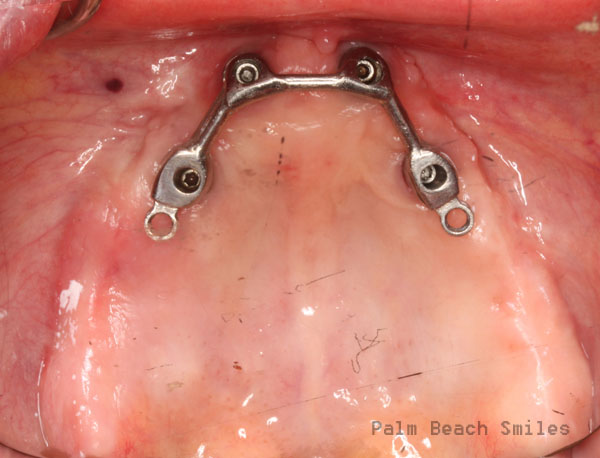 RL Implant Denture03