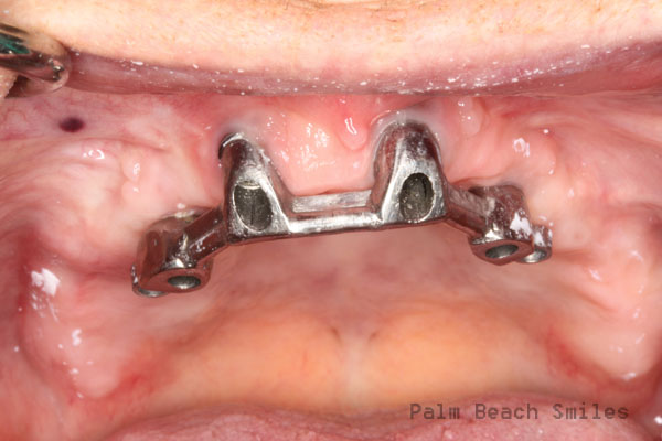 RL Implant Denture04