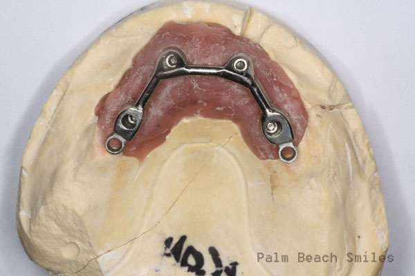 RL Implant Denture10