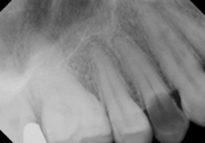 Pre-op x-ray from previous dentist.