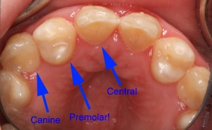 Lisa-occlusal-