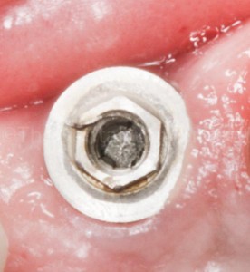 #9 - screw was deeper down inside the implant body.
