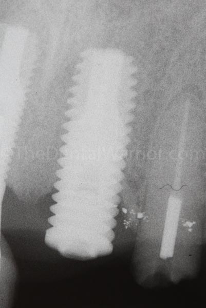 X-ray of #9 - 10