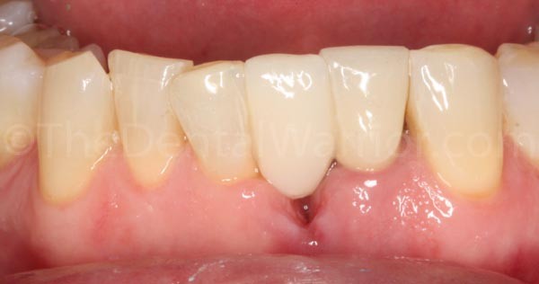 I sandblasted the proximal surfaces of the pontic and the adjacent teeth.  I applied silane (Interface by Apex).  Then bonded with Scotchbond Universal and a flowable composite.  