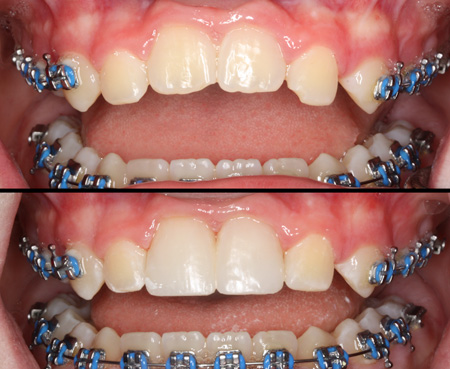 Ankylosed centrals resulted in a reverse smile line. Corrected with composite bonding.
