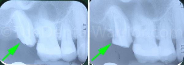 Before and after radiographs. Green arrow to point out the built-up distal axial wall.