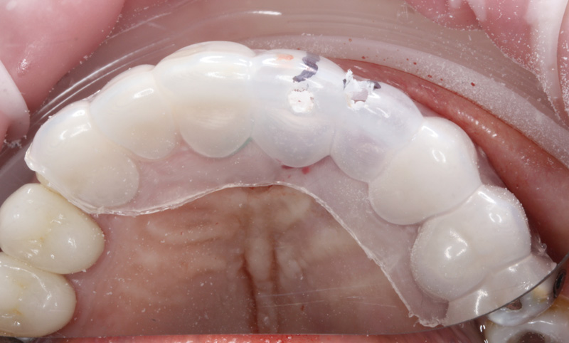 Another Immediate Implant Provisional Case | The Dental Warrior® – A ...